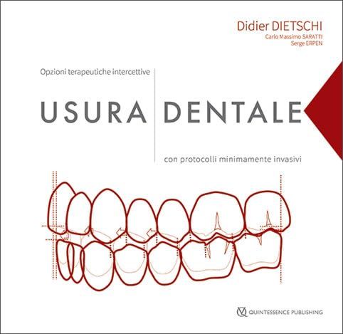 Usura dentale. Opzioni terapeutiche intercettive con protocolli minimamente invasivi