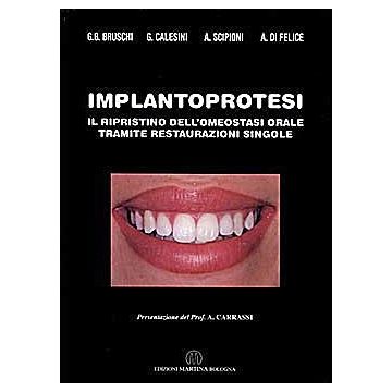 Implantoprotesi - Il ripristino dell’omeostasi orale tramite restaurazioni singole  