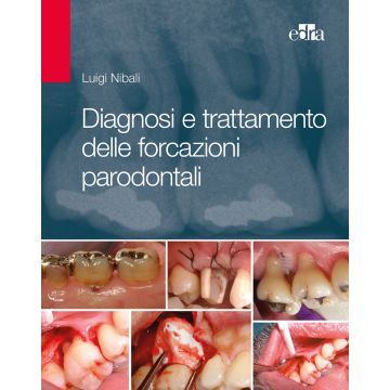 Diagnosi e Trattamenti delle Forcazioni Parodontali