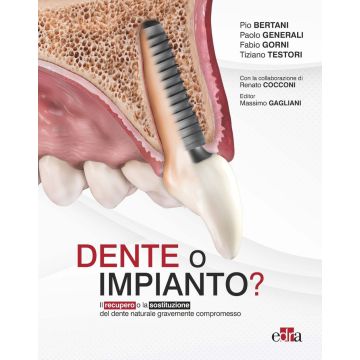 Dente o impianto? Il recupero o la sostituzione del dente naturale gravemente compromesso
