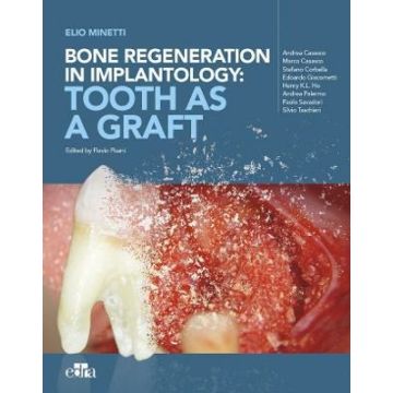 Bone regeneration in implantology: tooth as a graft