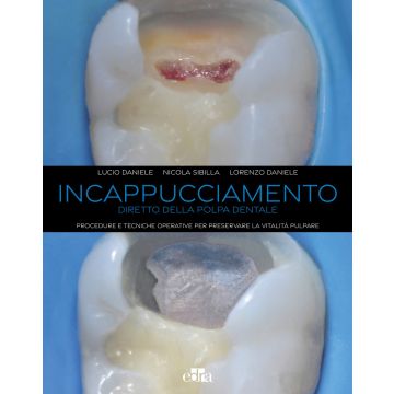 Incappucciamento diretto della polpa dentale. Procedure e tecniche operative per preservare la vitalità pulpare. Con QR code