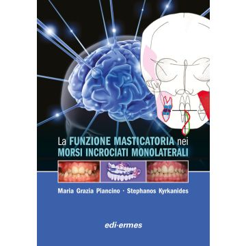 La Funzione Masticatoria nei Morsi Incrociati Monolaterali 