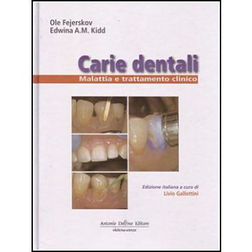 CARIE DENTALI. Malattia e Trattamento Clinico