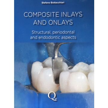 Composite inlays and onlays