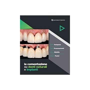La Cementazione su denti naturali e impianti