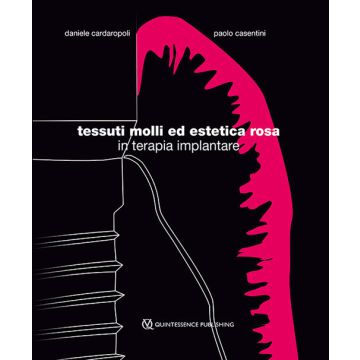 Tessuti molli ed estetica rosa in Terapia Implantare