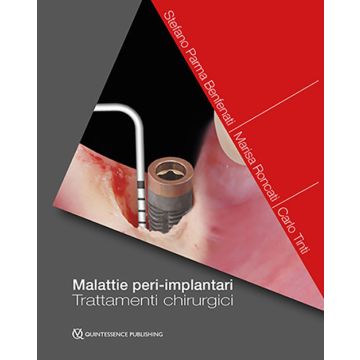 Malattie peri-implantari - Trattamenti chirurgici