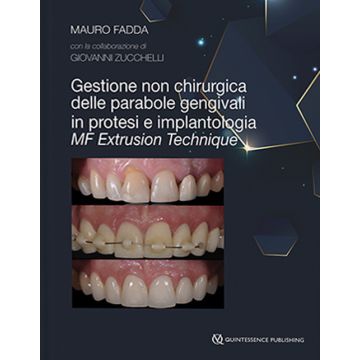 MF EXTRUSION Technique - Gestione non chirurgica delle parabole gengivali in Protesi e Implantologia
