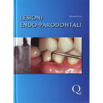Lesioni Endo - Parodontali