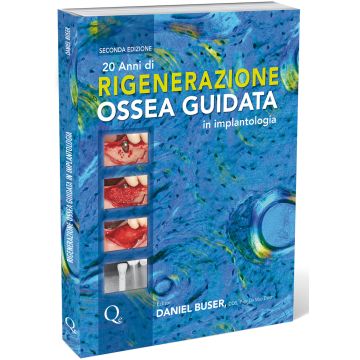 20 anni di Rigenerazione Ossea Guidata in implantologia