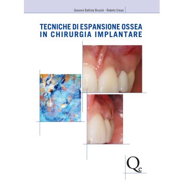 Tecniche di espansione ossea in chirurgia implantare