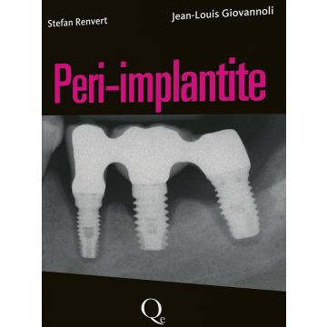 Peri - Implantite