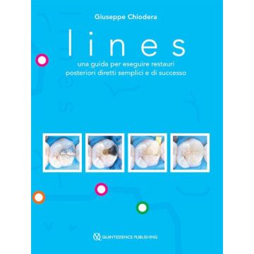 Lines. Una guida per eseguire restauri posteriori diretti semplici e di successo