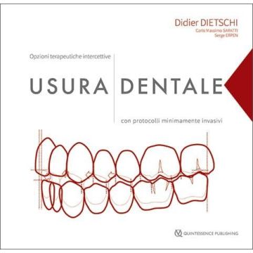 Usura dentale. Opzioni terapeutiche intercettive con protocolli minimamente invasivi