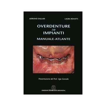 Overdenture su impianti - Manuale atlante