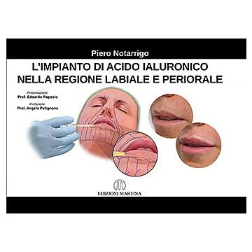 L'Impianto di acido ialuronico nella regione labiale e periorale