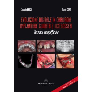 Evoluzione digitale in Chirurgia Implantare guidata e iuxtaossea