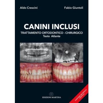 Canini Inclusi. Trattamento Ortodontico-Chirurgico – Testo Atlante