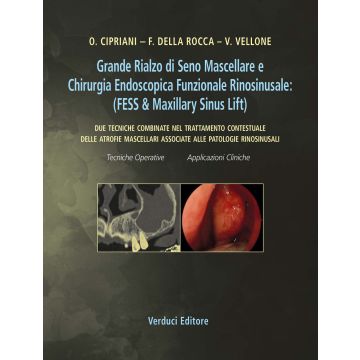 Grande Rialzo di Seno Mascellare e Chirurgia Endoscopica Funzionale Rinosinusale: (FESS Due tecniche combinate nel trattamento contestuale delle atrofie mascellari associate alle patologie rinosinusali