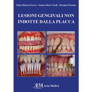 Lesioni gengivali non indotte dalla placca